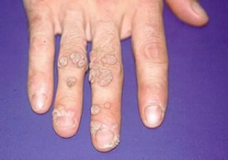 Cum scapam de negi prin metode naturiste